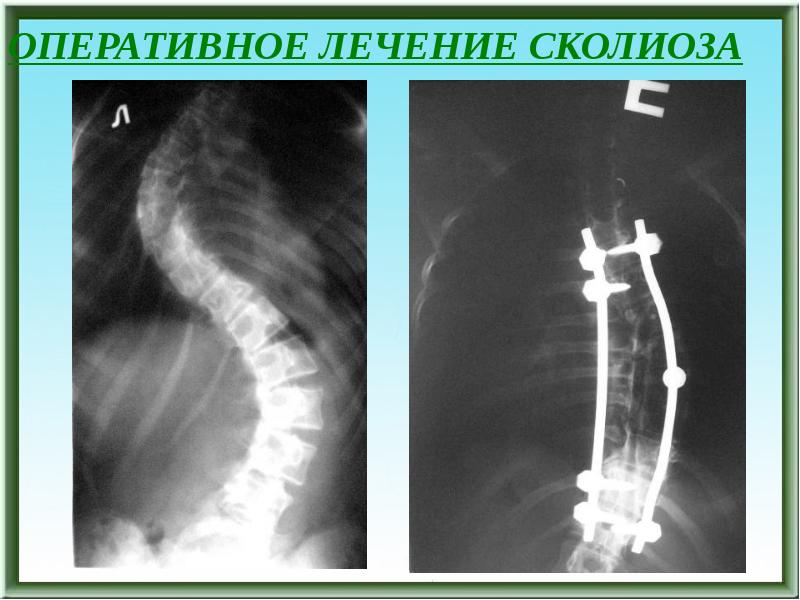 Хирургическое лечение сколиоза презентация