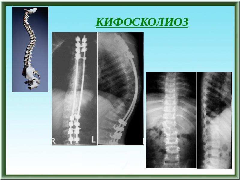 Сколиоз позвоночника презентация травматология