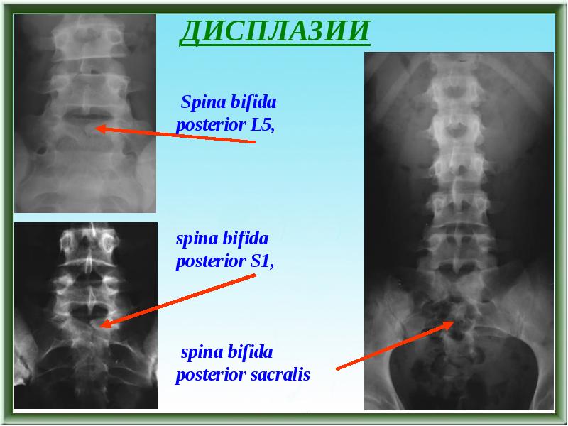 Расщепление позвоночника презентация