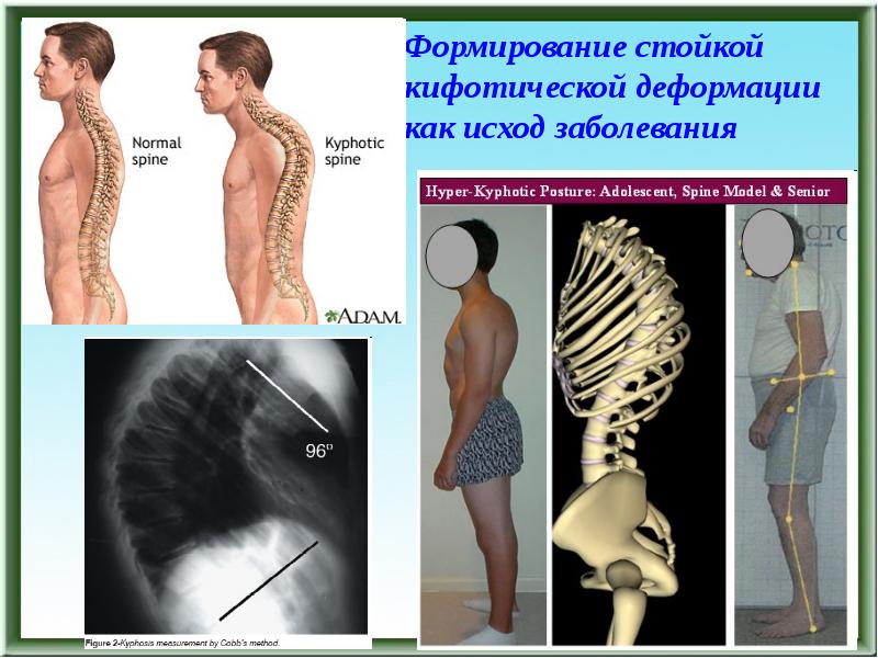 Врожденные деформации позвоночника презентация