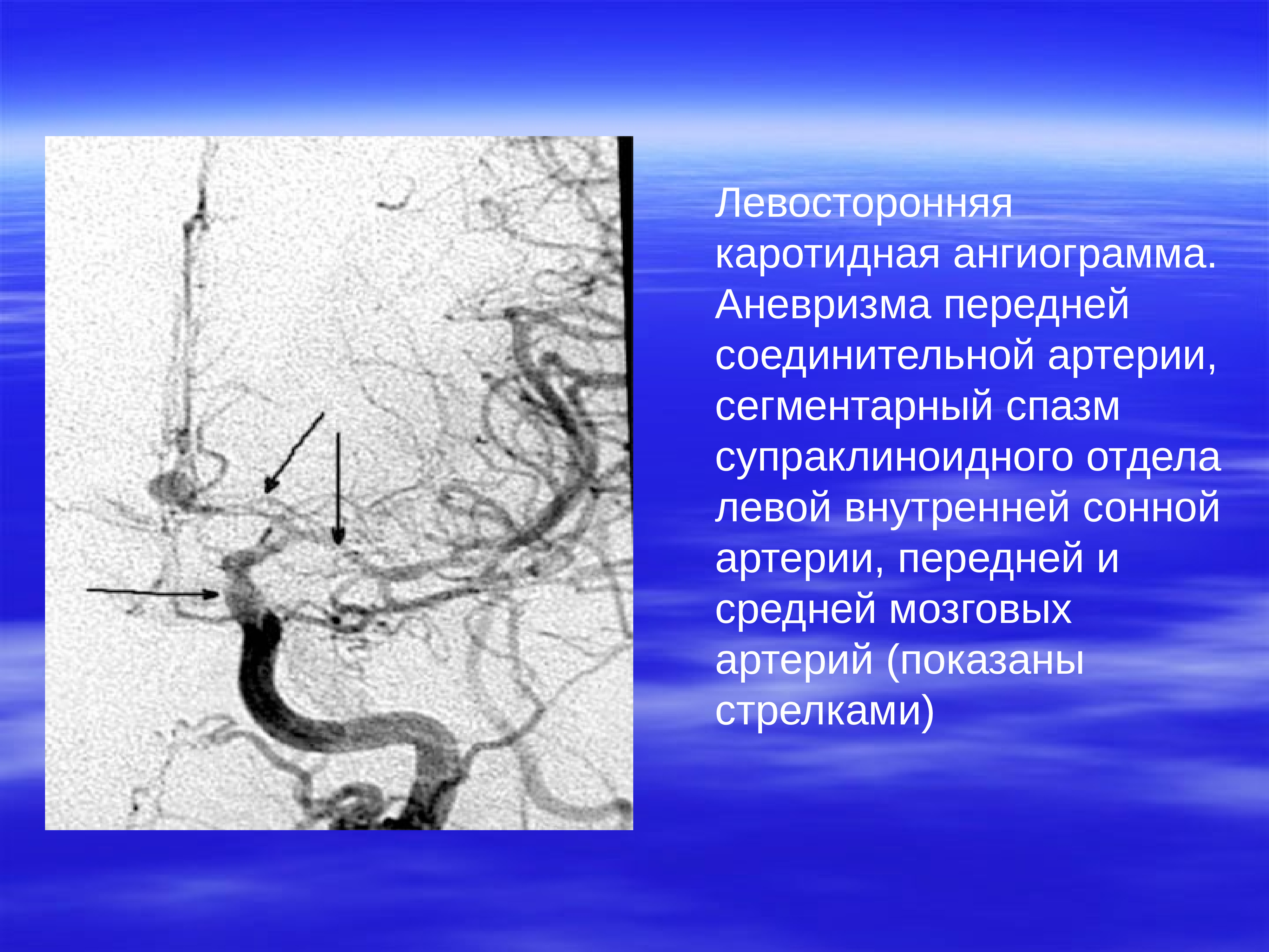Аневризма сонной артерии что это. Аневризма коммуникантного сегмента ВСА. Супраклиноидный отдел ВСА аневризма. Аневризма левой внутренней сонной артерии сегмент с6. Супраклиноидный отдел внутренней сонной артерии на кт.