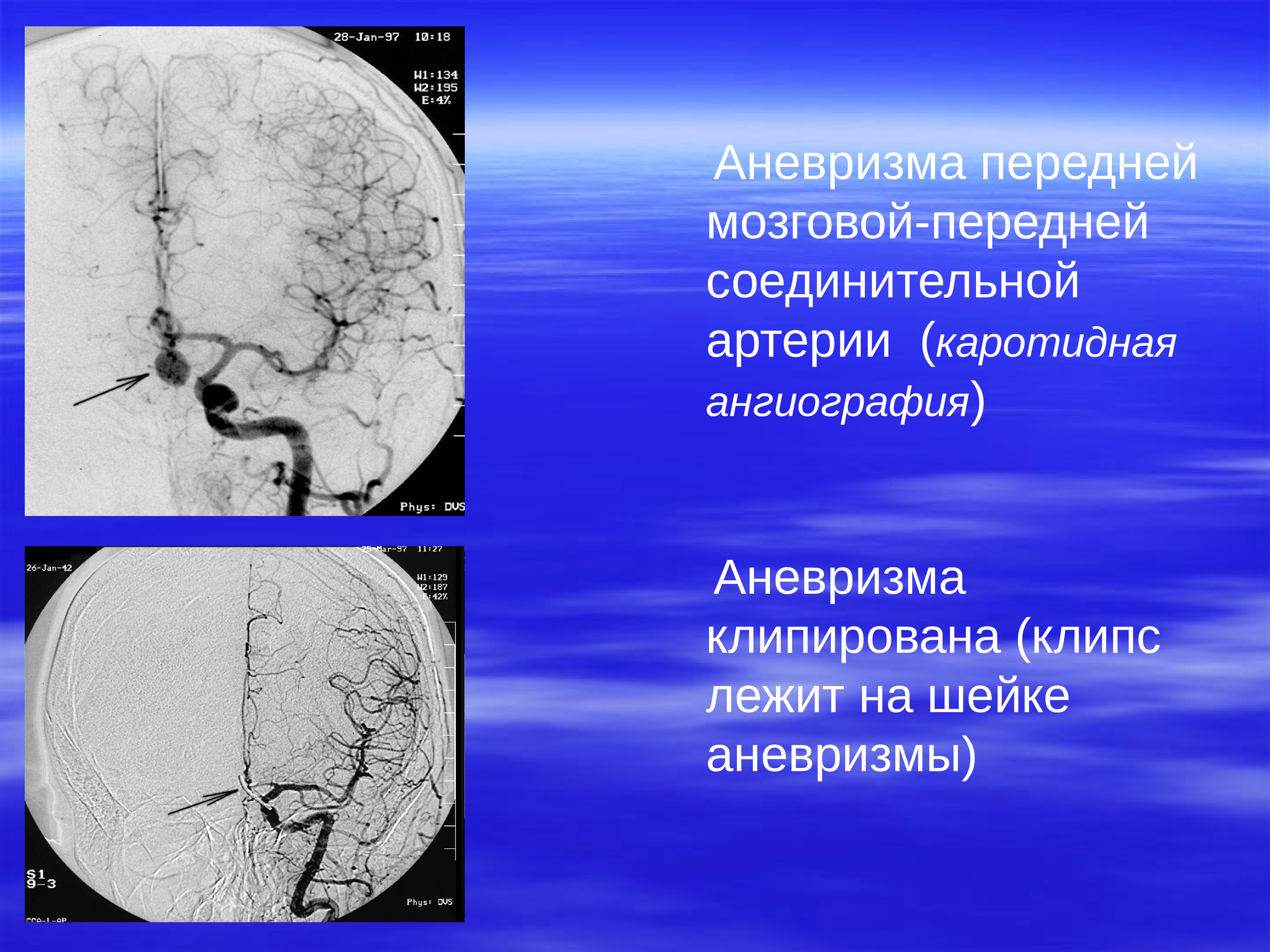 Аневризма головного мозга. Аневризма средней мозговой артерии головного мозга. Аневризма мозговых артерий кт. Передняя соединительная артерия головного мозга аневризма. Аневризма передней мозговой артерии головного мозга.