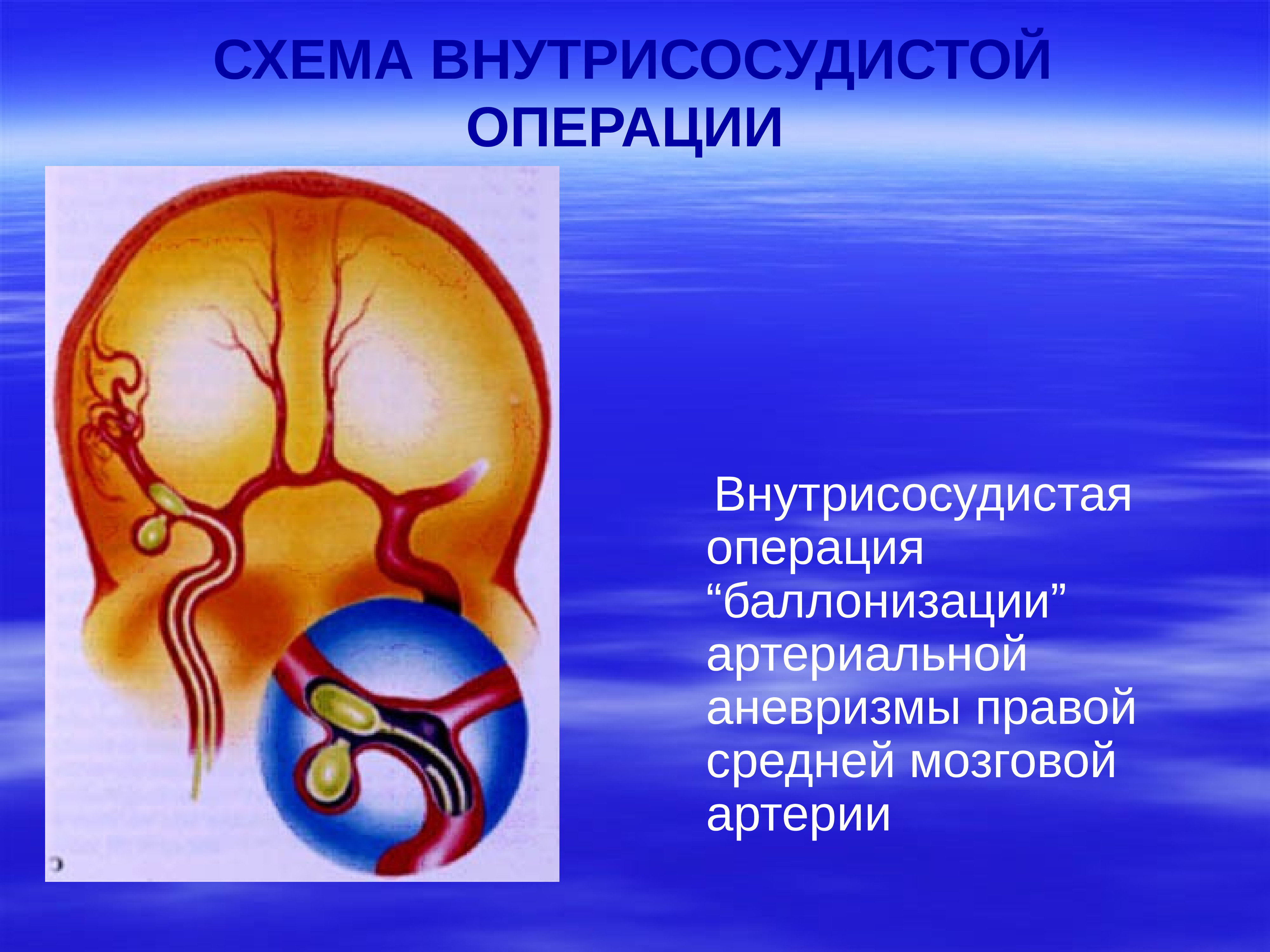 Аневризма сонной артерии что это. Аневризмы головного мозга презентация. Аневризма правой средней мозговой артерии. Средняя мозговая артерия.