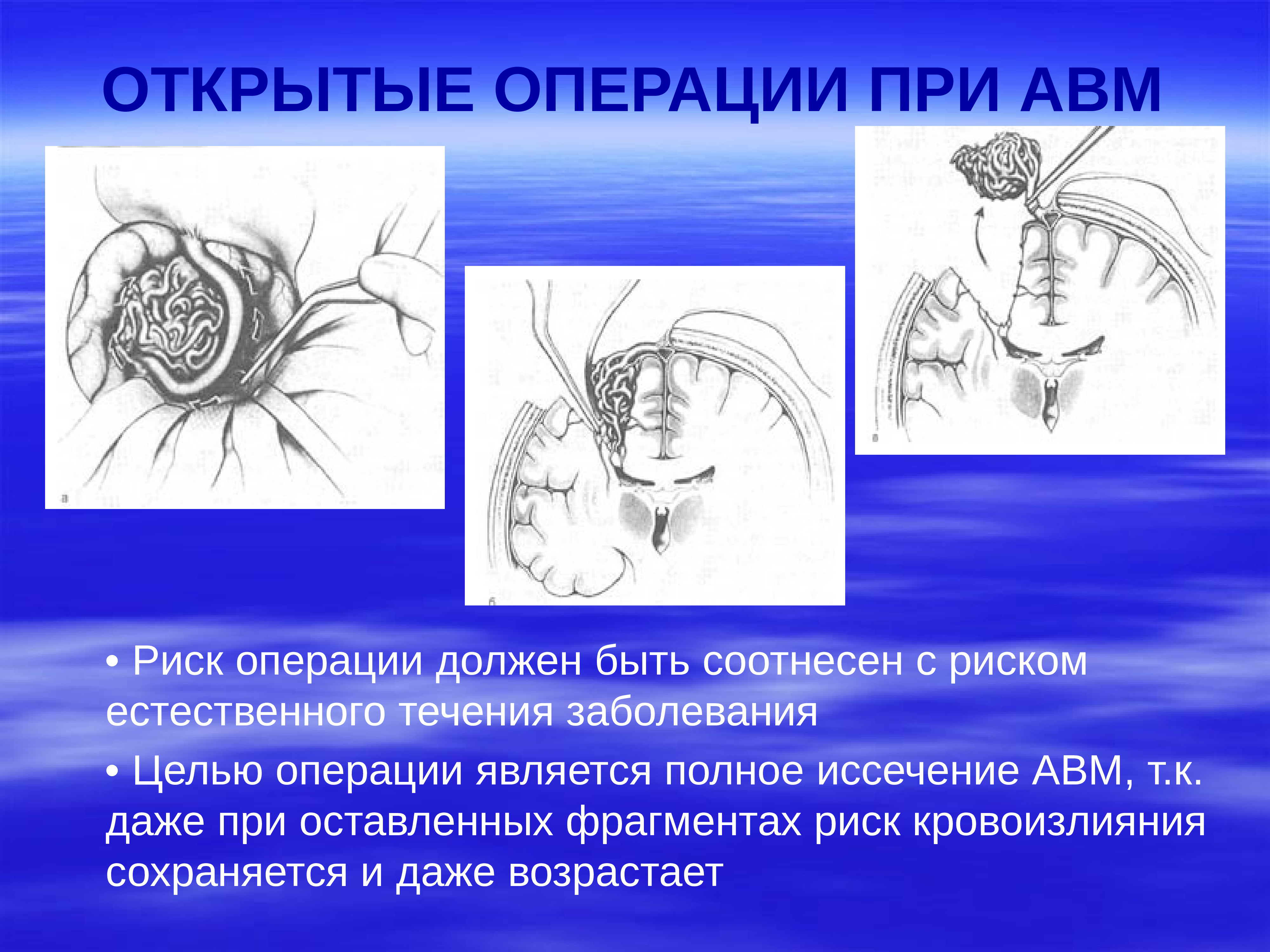 Операции должен. Операция АВМ головного мозга.