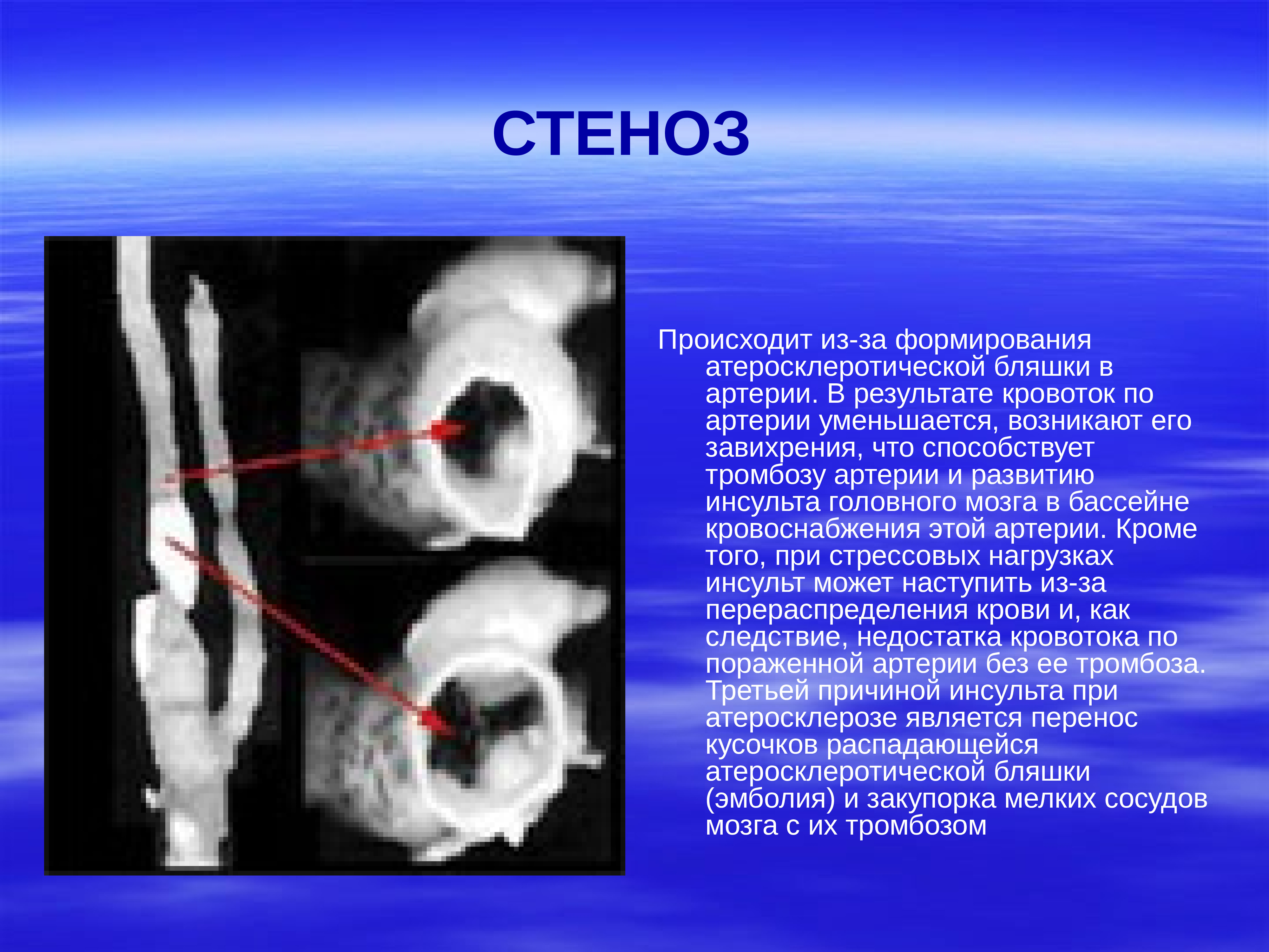 Что такое стеноз. Критический стеноз артерии процент.