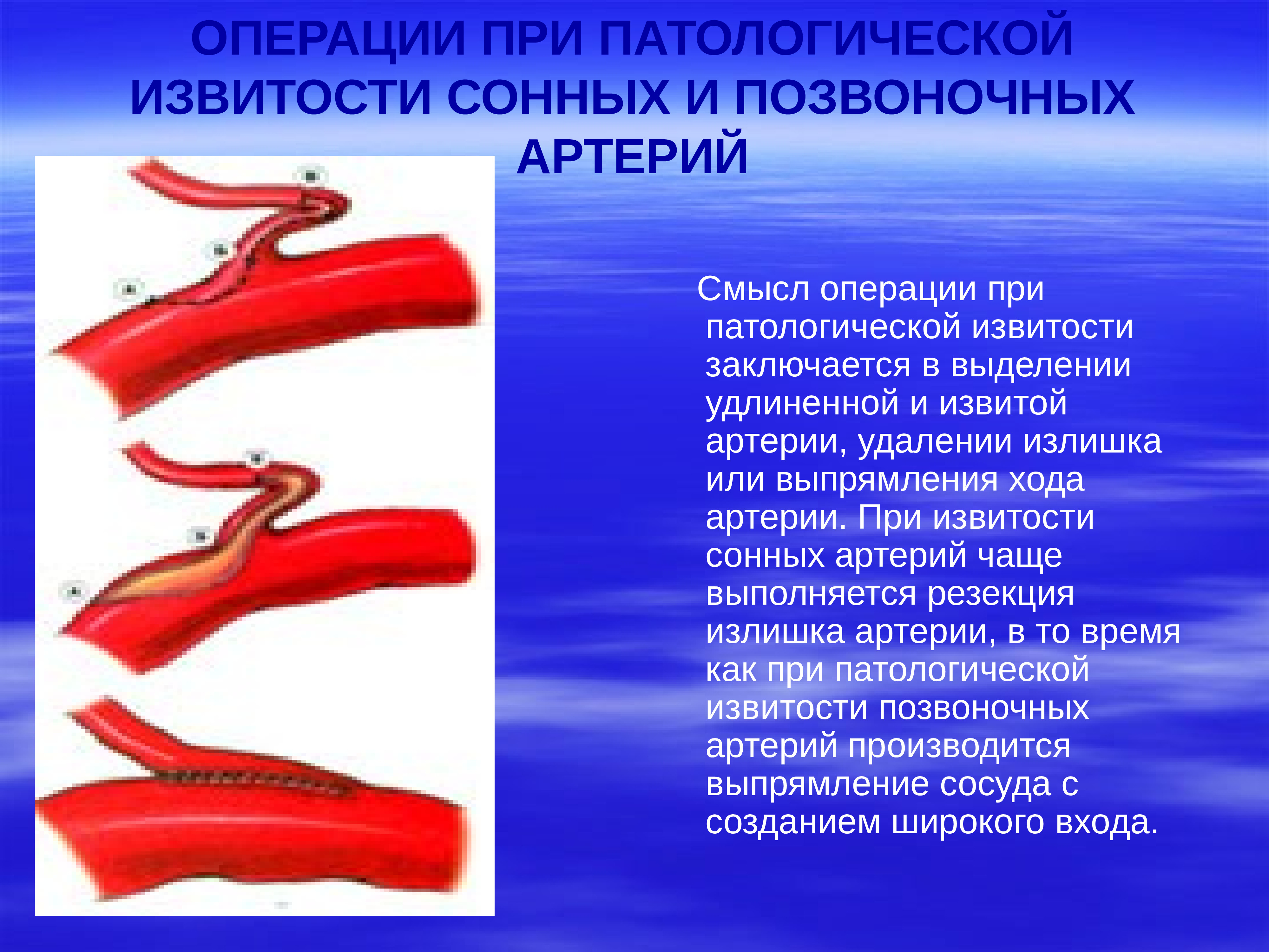 Сужение правой артерии. Патологические изгибы обеих внутренних сонных артерий. Патологическая извитость артерий (кинкинг). Патологическая извитость сонных артерий койлинг. Патологическая извитость внутренней сонной артерии.