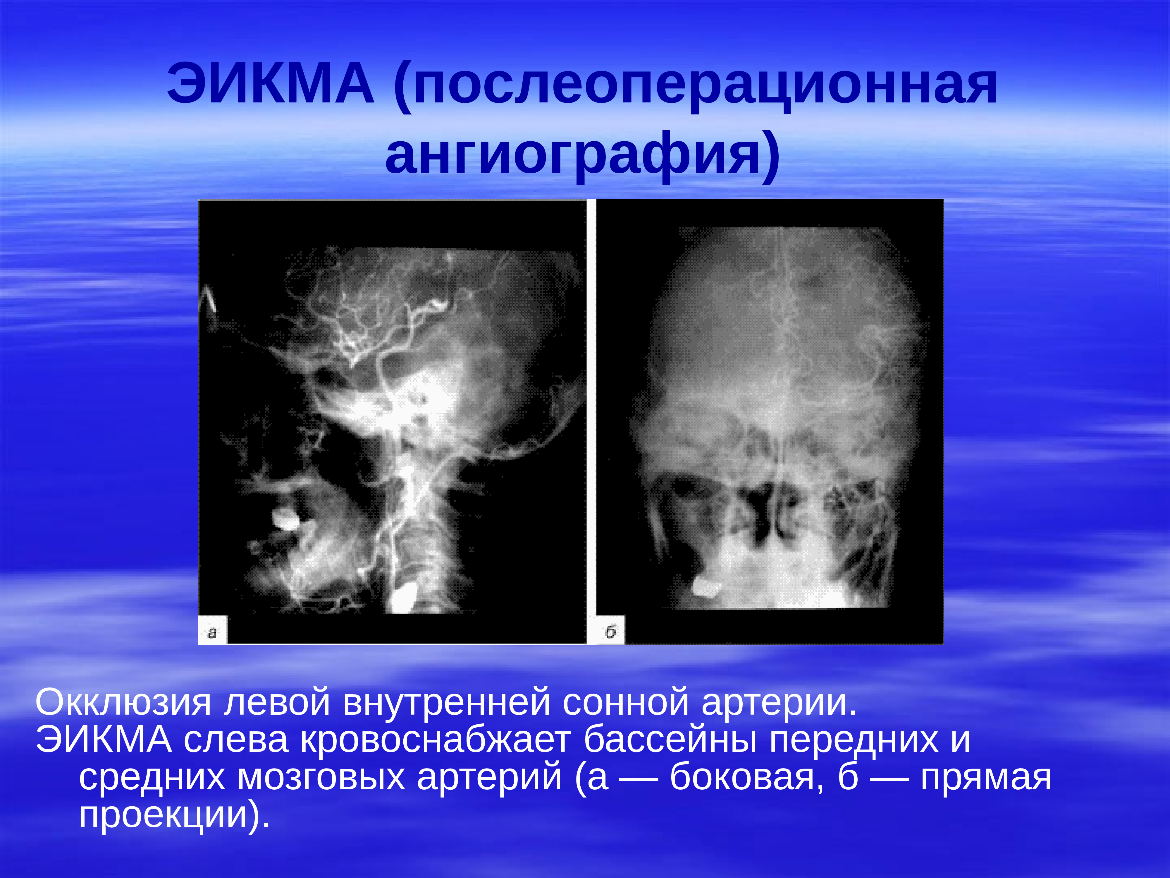 Окклюзия головного мозга. Окклюзия внутренней сонной артерии. Окклюзия средней мозговой артерии ангиография. Экстра- интракраниального микроанастомоза.