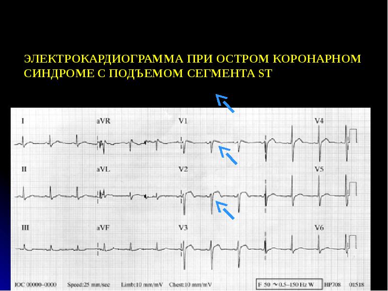 Подъем сегмента st. Подъем сегмента St на ЭКГ при ИБС. ЭКГ при остром панкреатите. Временные рамки при Окс ЭКГ. Синдром 51 52 53 ЭКГ что это.