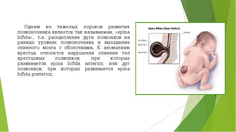 Расщепление позвоночника презентация