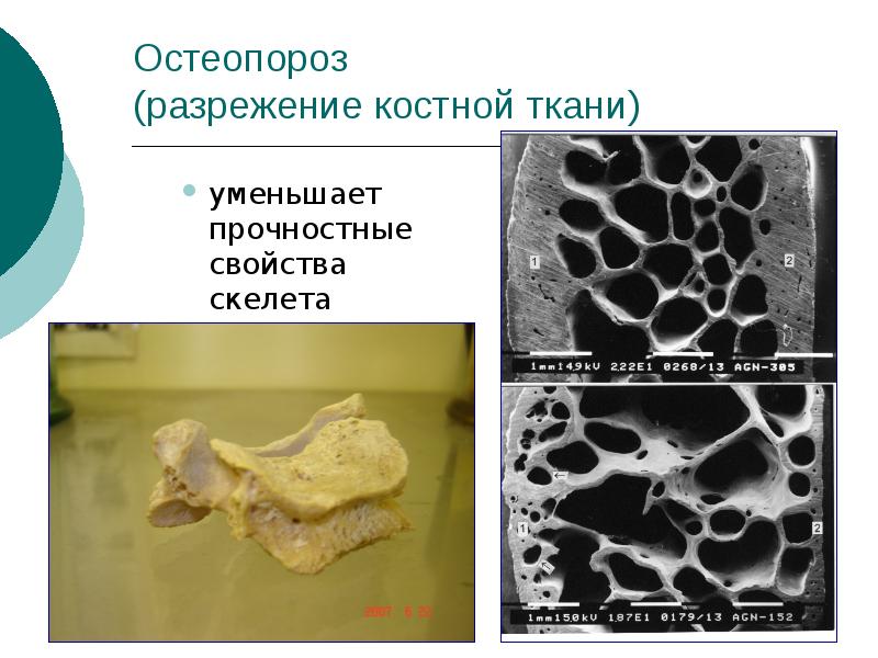 Остеопороз у детей презентация