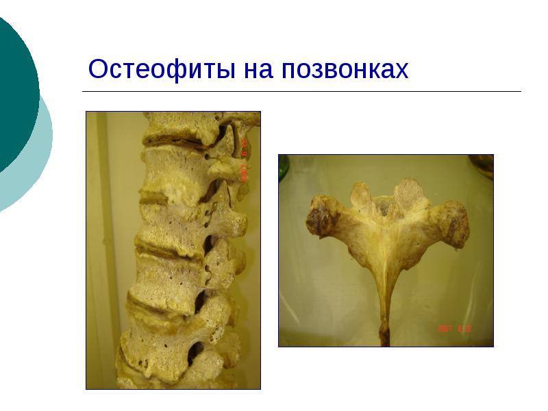 Краевые остеофиты тел позвонков что это такое фото