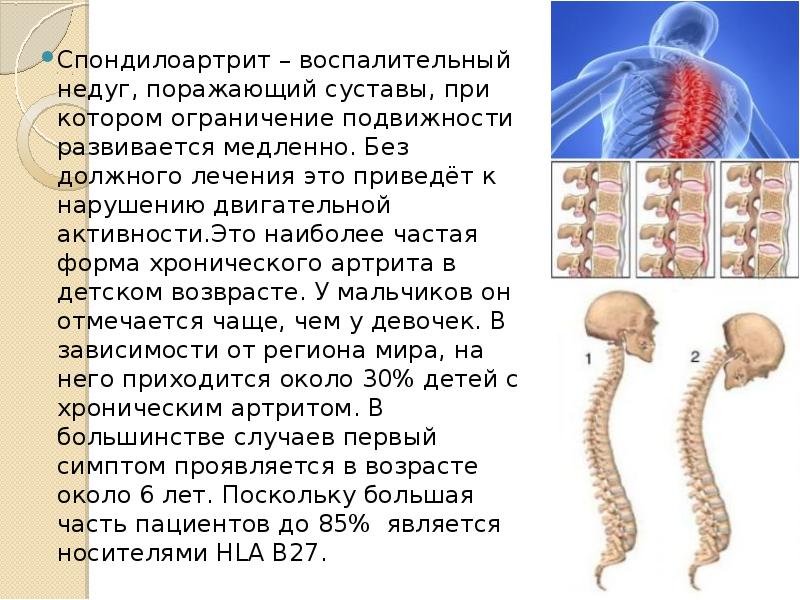 Анкилозирующий спондилоартрит презентация