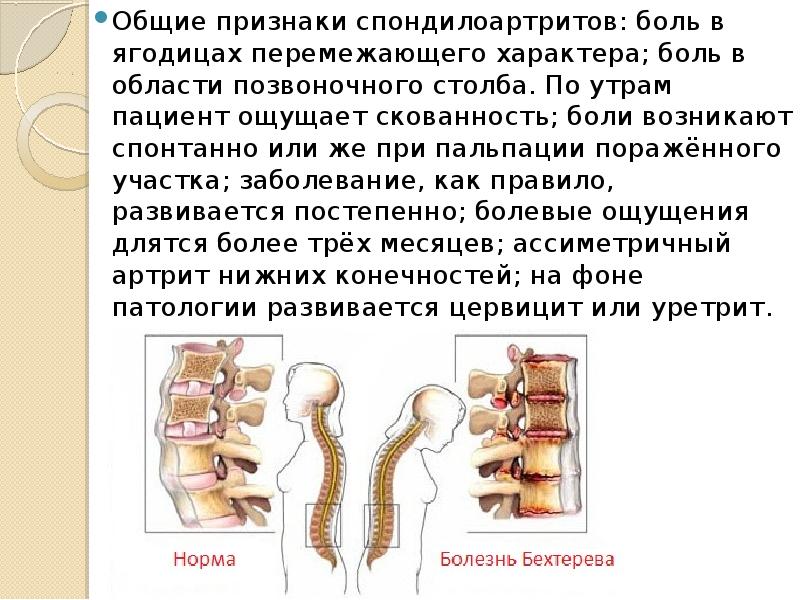 Анкилозирующий спондилоартрит презентация