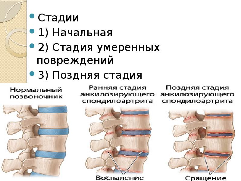 Анкилозирующий спондилит презентация