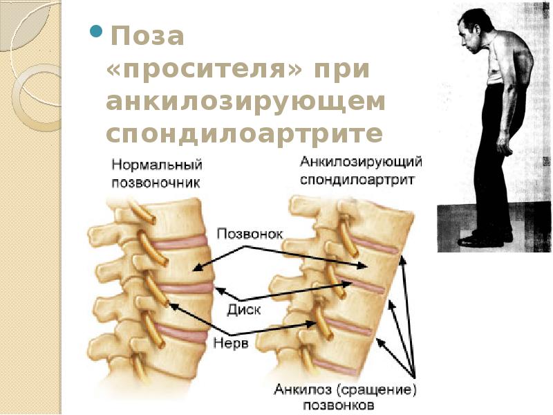 Анкилозирующий спондилоартрит презентация