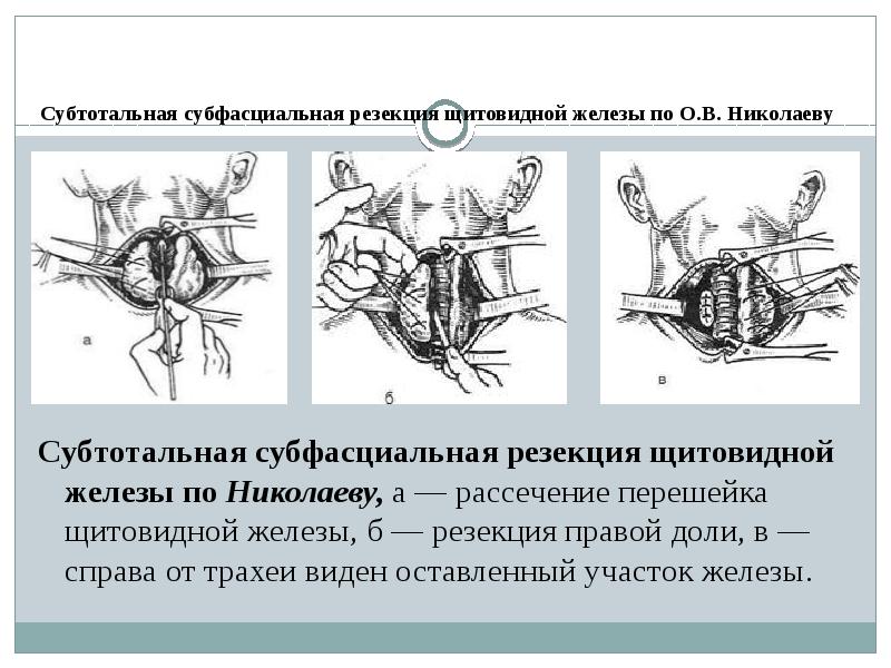 Субтотальная гистерэктомия презентация