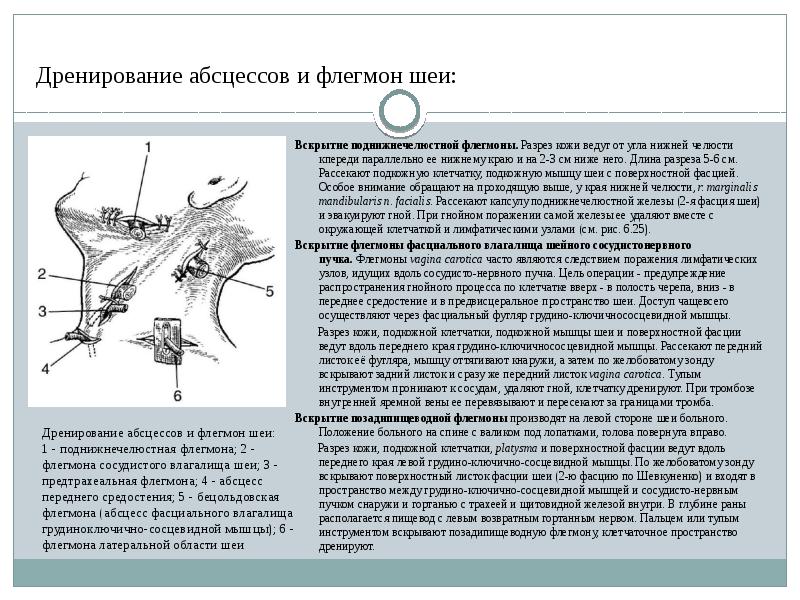 Варианты расположения абсцессов флегмон височной области