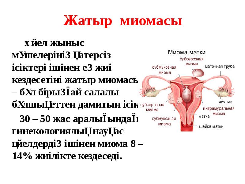 Жатыр миомасы
Әйел жыныс мүшелерінің қатерсіз ісіктері Жатыр миомасы
Әйел жыныс мүшелерінің қатерсіз ісіктері