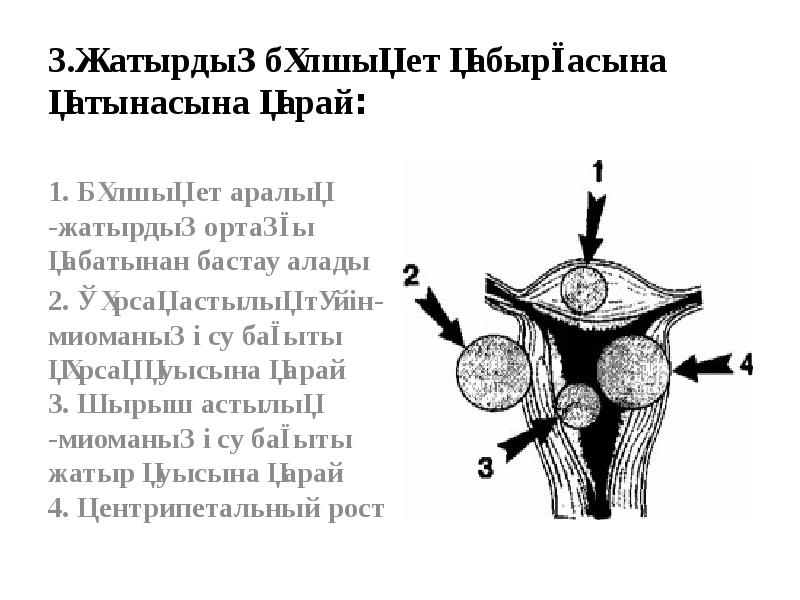 3.Жатырдың бұлшық ет қабырғасына қатынасына қарай:
1. Бұлшық ет аралық 3.Жатырдың бұлшық ет қабырғасына қатынасына қарай:
1. Бұлшық ет аралық