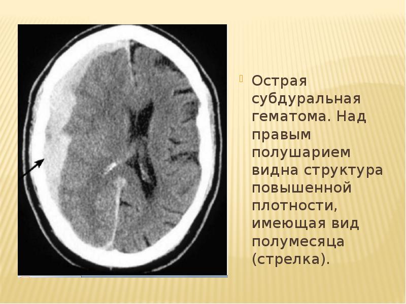 Постоперационные изменения головного мозга при компьютерной томографии