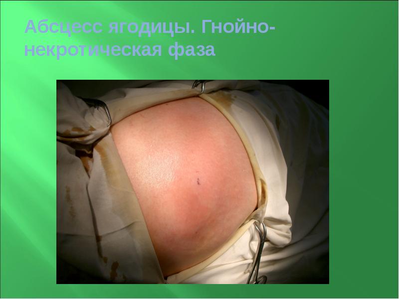 Абсцесс ягодицы. Гнойно-некротическая фаза