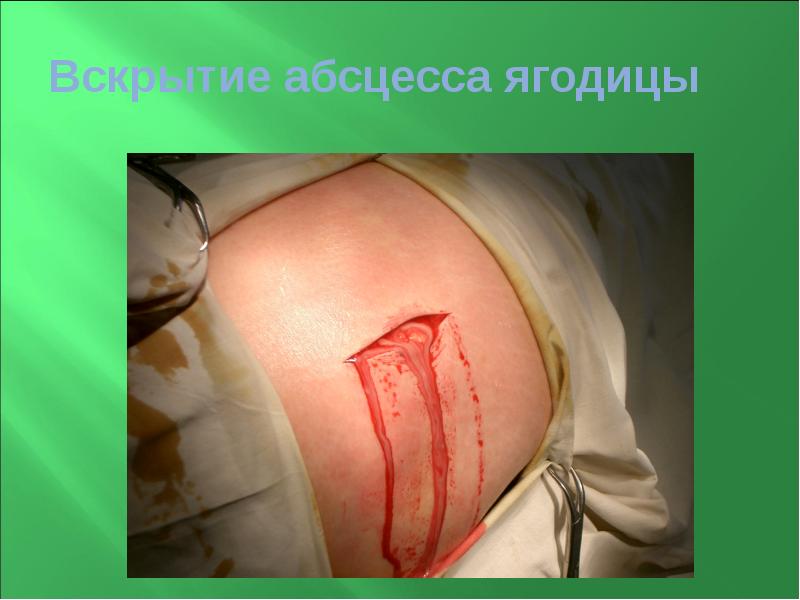 Вскрытие абсцесса ягодицы