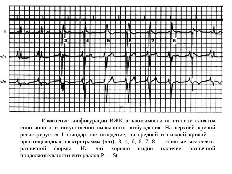 Изменяемая конфигурация. Электрограмма. Сетчатка электрограмма. Изменение конфигурации. График электрограммы.