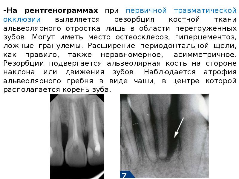 Резорбция это. Резорбция кости остеокластами. Патологическая резорбция костной ткани. Резорбция большеберцовой кости. Классификация резорбции костной ткани.