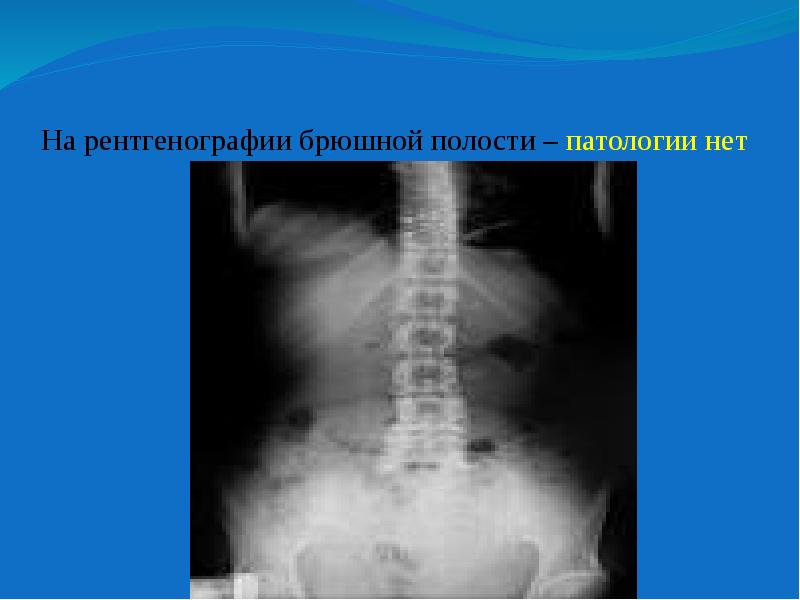 Рентген брюшной полости фото норма