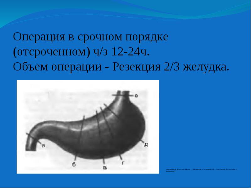 Объем операции. Уровни резекции желудка. Серповидная резекция по Куслику. Срочный порядок операции.