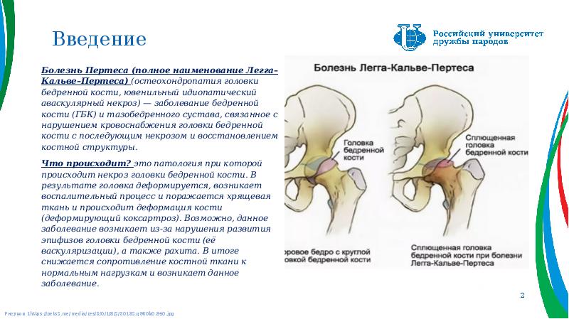 Болезнь пертеса презентация