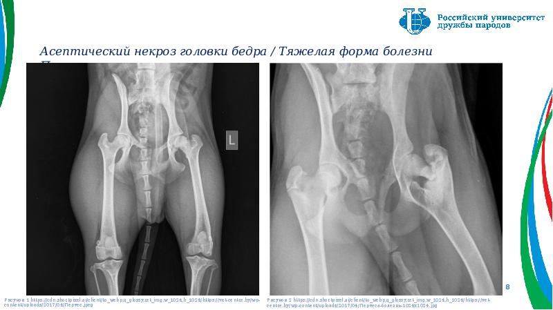 Презентация болезнь пертеса