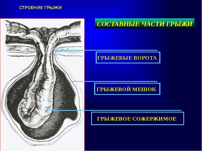 Вентральные грыжи презентация