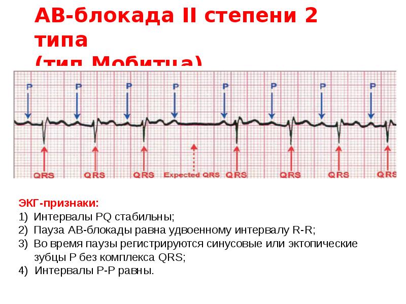 Ав блокада 2 степени