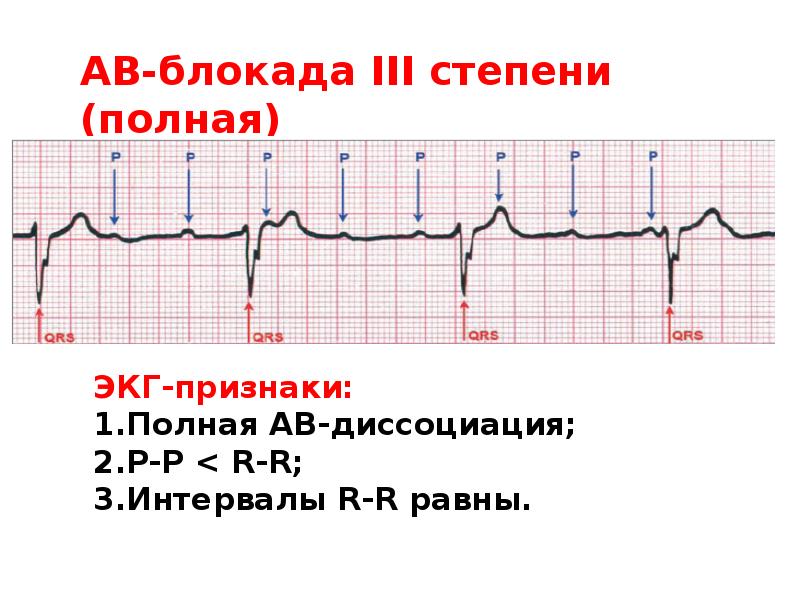 Признаки синоатриальной блокады