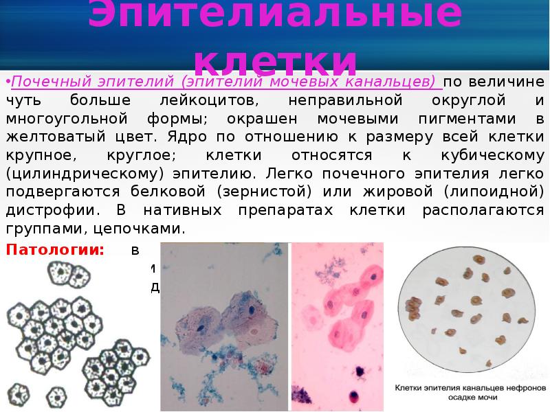 Эпителиальные клетки в моче норма