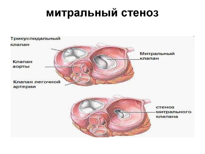 Презентация по патологии пороки сердца