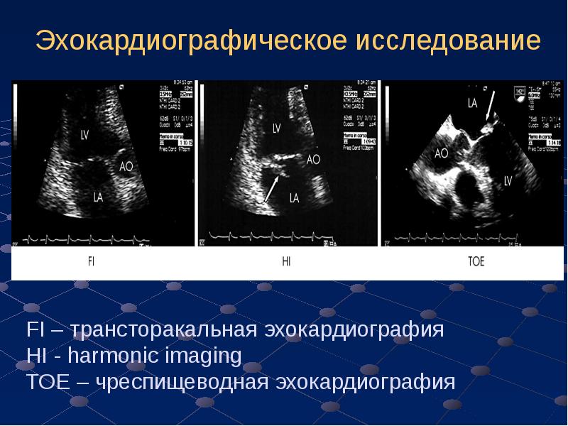 Чреспищеводная эхокардиография презентация