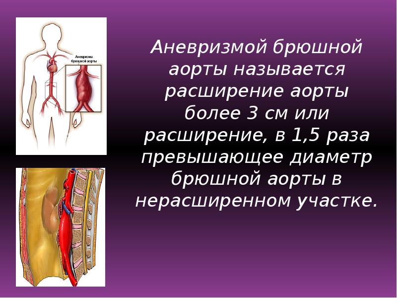 Как проверить брюшную аорту. Аневризма инфраренального отдела брюшной аорты.