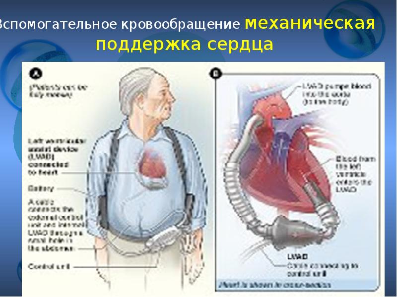 Вспомогательное кровообращение механическая поддержка сердца  Вспомогательное кровообращение механическая поддержка сердца