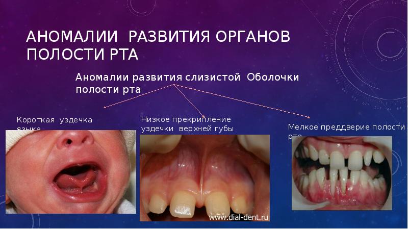 Аномалии развития органов полости рта Аномалии развития органов полости рта