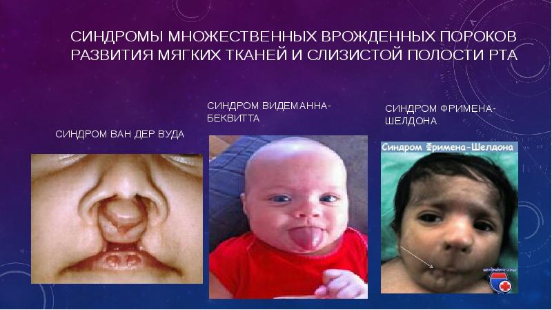 СИНДРОМЫ МНОЖЕСТВЕННЫХ ВРОЖДЕННЫХ ПОРОКОВ РАЗВИТИЯ МЯГКИХ ТКАНЕЙ И СЛИЗИСТОЙ ПОЛОСТИ РТА СИНДРОМЫ МНОЖЕСТВЕННЫХ ВРОЖДЕННЫХ ПОРОКОВ РАЗВИТИЯ МЯГКИХ ТКАНЕЙ И СЛИЗИСТОЙ ПОЛОСТИ РТА