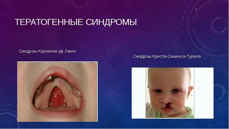 ТЕРАТОГЕННЫЕ СИНДРОМЫ ТЕРАТОГЕННЫЕ СИНДРОМЫ