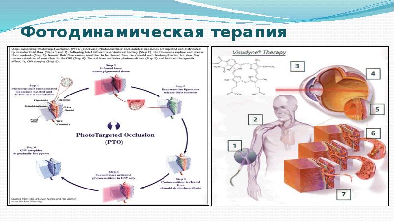 Фотодинамическая терапия Фотодинамическая терапия