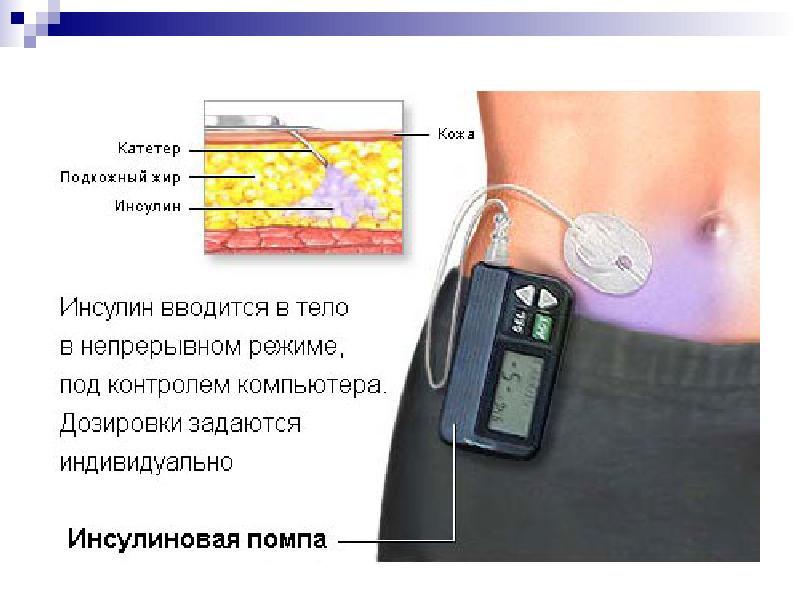 Помпа для диабетиков как выглядит фото на человеке