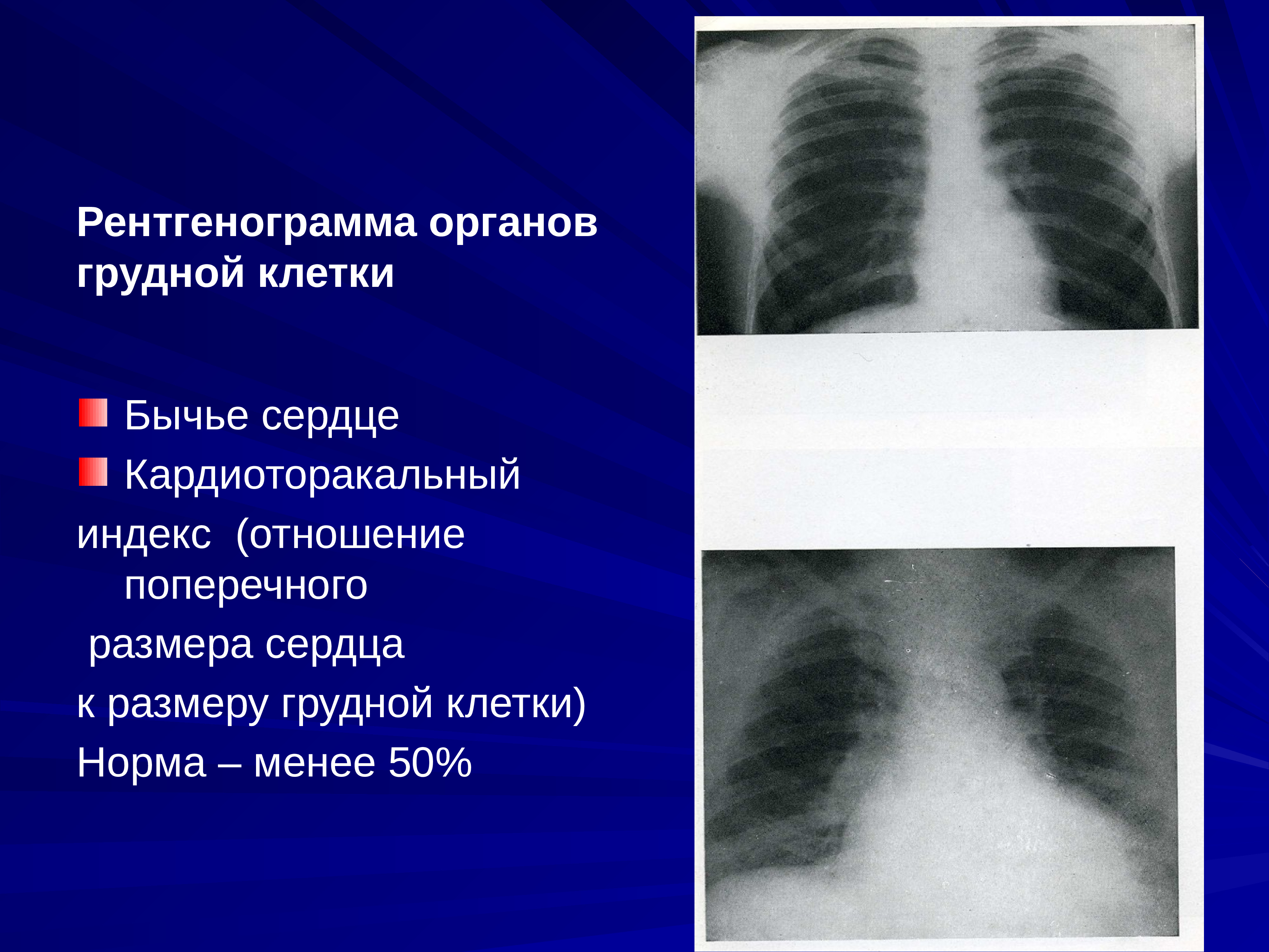 бычье сердце диагноз у человека что это