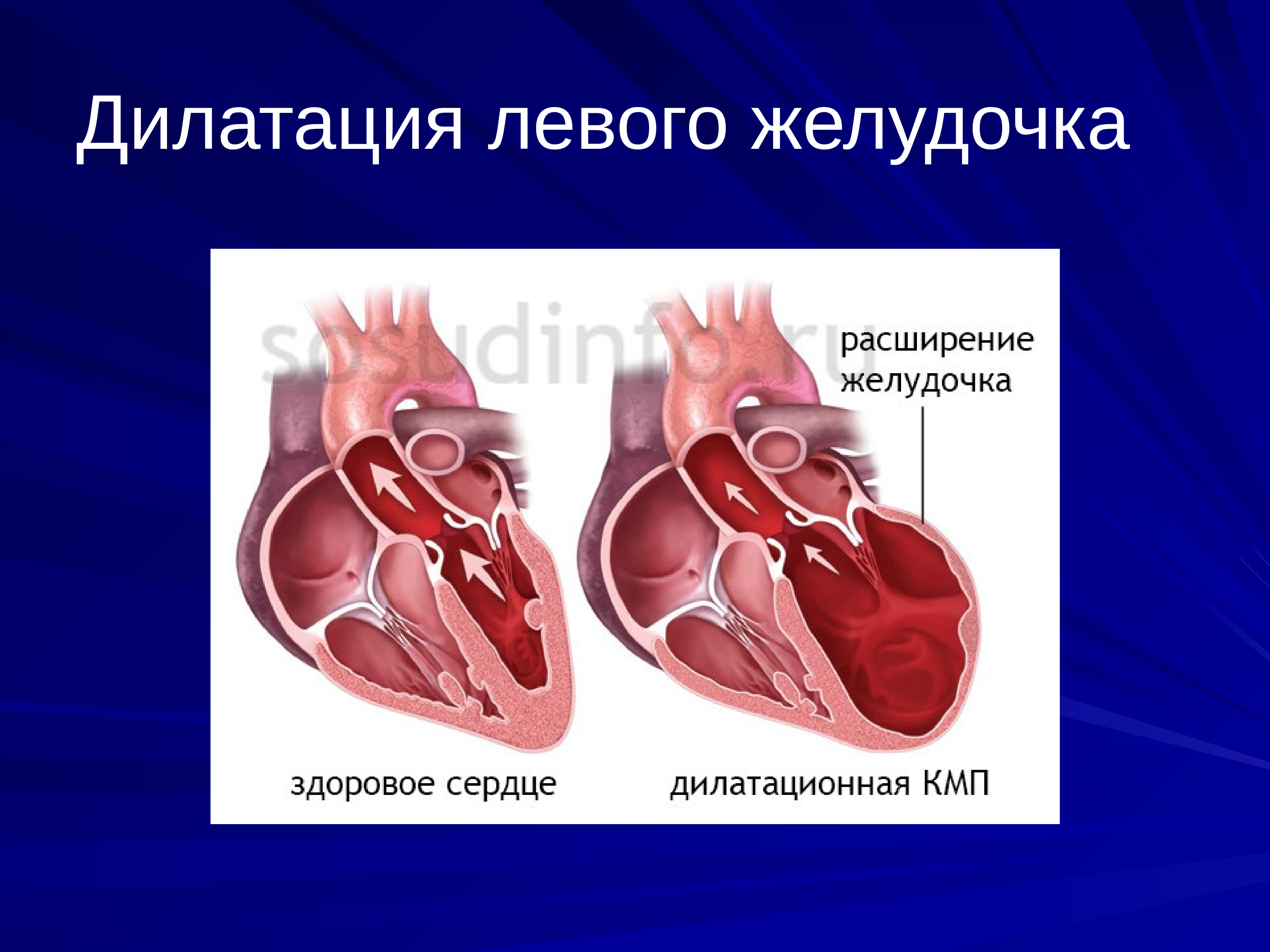 Желудочка сердца расширена. Дилатация предсердий и желудочков. Дилатация левого желудочка сердца. Дилатация желудочков сердца. Дилатация левых отделов сердца.