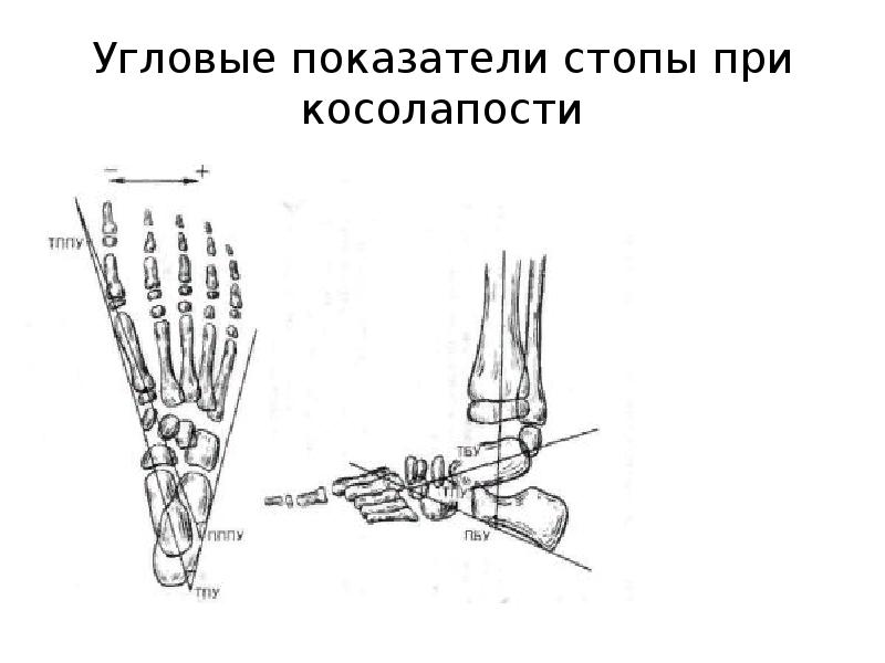 Углы стопы. Таранно пяточный угол при врожденной косолапости. Косолапость Рентгенометрия. Таранно пяточный угол при косолапости. Косолапость рентгенодиагностика.