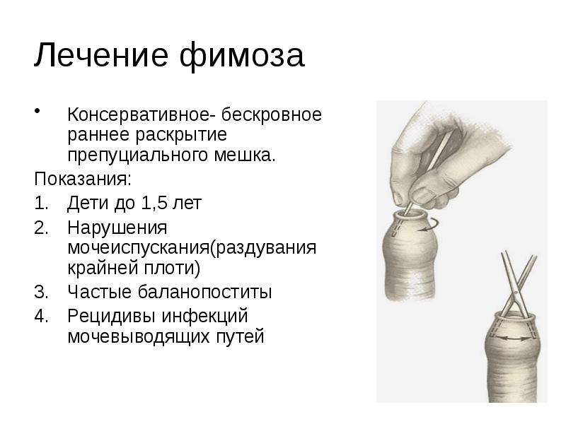 Фимоз у детей. Фимоз у детей лечение. Фомоз.