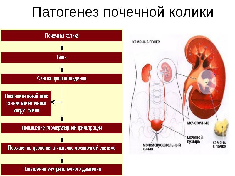 Почечная колика. Патогенез мочекаменной болезни почек. Патогенез почечной колики. Почечная колика этиология. Патогенез заболеваний почек.